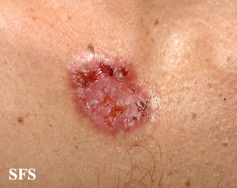 Basal Cell Carcinoma (Dermatology Atlas 164).jpg