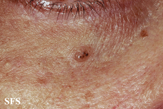 Basal Cell Carcinoma (Dermatology Atlas 255).jpg
