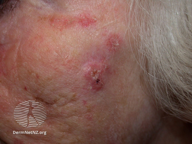 Basal cell carcinoma affecting the face (DermNet NZ lesions-bcc-face-0960).jpg