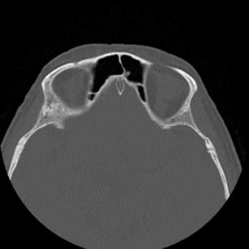 File:Base of skull chondrosarcoma (Radiopaedia 30410-31071 Axial bone window 33).jpg