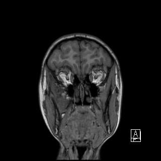 Base of skull rhabdomyosarcoma (Radiopaedia 32196-33142 Coronal T1 6).jpg