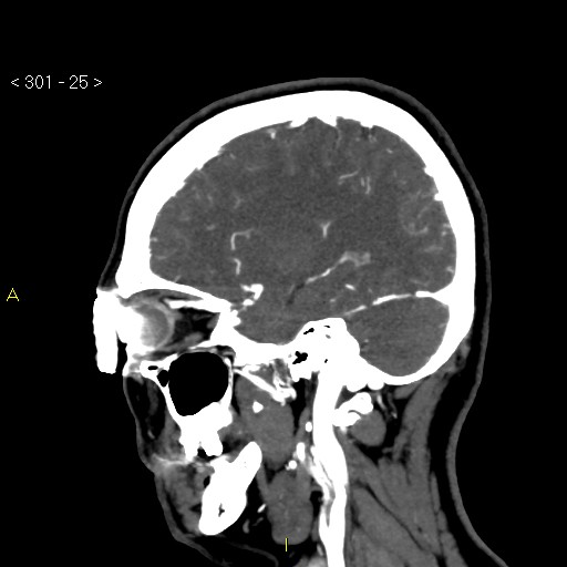 Basilar artery thrombosis (Radiopaedia 16260-15944 C 19).jpg