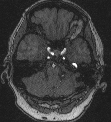 Basilar tip aneurysm (Radiopaedia 26504-26632 MRA 45).jpg