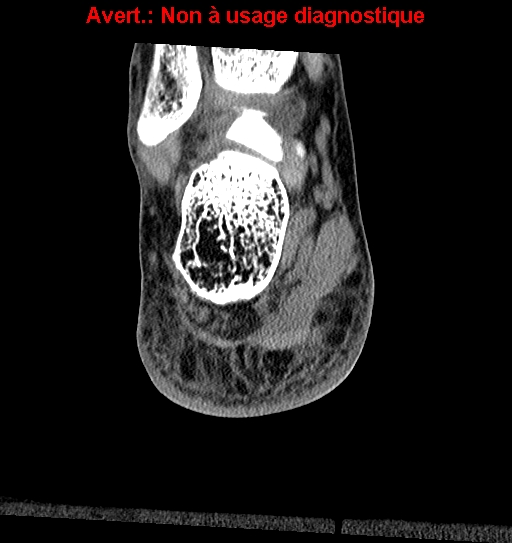 Baxter neuropathy (Radiopaedia 25988-26125 Coronal non-contrast 32).jpg