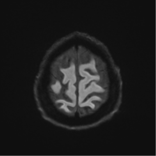 Behavioral variant frontotemporal dementia and late onset schizophrenia (Radiopaedia 52197-58083 Axial DTI Trace W 51).png