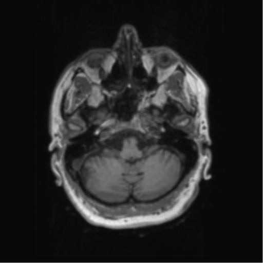 File:Behavioral variant frontotemporal dementia and late onset schizophrenia (Radiopaedia 52197-58083 Axial T1 91).png