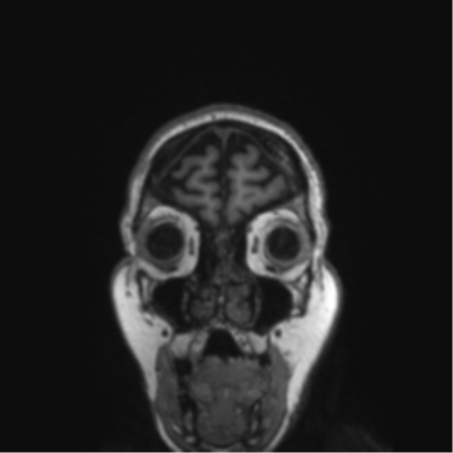 Behavioral variant frontotemporal dementia and late onset schizophrenia (Radiopaedia 52197-58083 Coronal T1 81).png