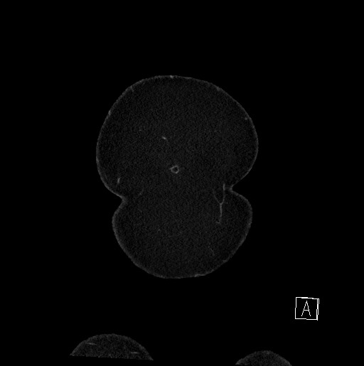 Below filter IVC thrombosis (Radiopaedia 58187-65266 B 13).jpg
