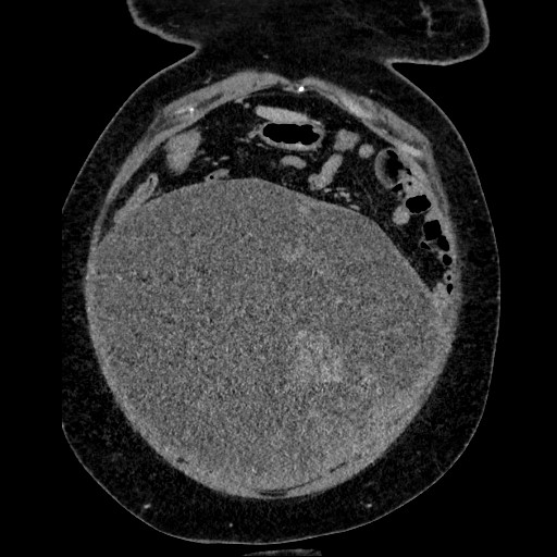 Benign leiomyoma with hydropic features (Radiopaedia 89250-106130 B 35).jpg