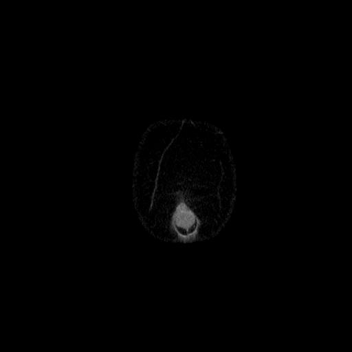 File:Benign spindle cell tumor - abdominopelvic (Radiopaedia 61300-69212 C 1).jpg