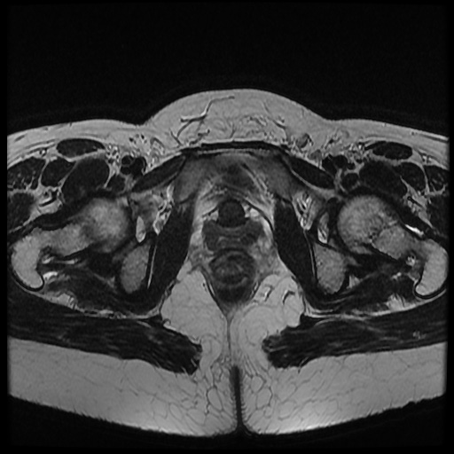 File:Bicornuate uterus (Radiopaedia 51676-57472 Axial T2 10).jpg