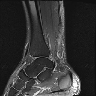 File:Bilateral Achilles tendon complete tear (Radiopaedia 81344-95051 Sagittal T2 fat sat 20).jpg