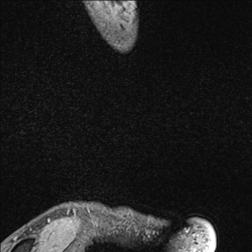 Bilateral Achilles tendon complete tear (Radiopaedia 81344-95051 Sagittal WE - Left 13).jpg