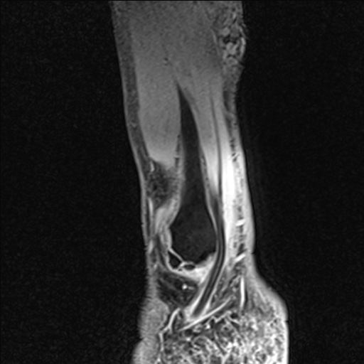 File:Bilateral Achilles tendon complete tear (Radiopaedia 81344-95051 Sagittal WE - Right 20).jpg