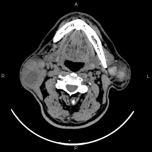 File:Bilateral Warthin tumors (Radiopaedia 84034-99263 Axial non-contrast 29).jpg