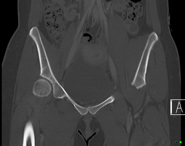 File:Bilateral acetabular fractures (Radiopaedia 79272-92308 Coronal bone window 12).jpg