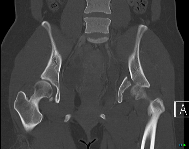 File:Bilateral acetabular fractures (Radiopaedia 79272-92308 Coronal bone window 20).jpg