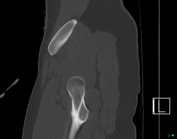 Bilateral acetabular fractures (Radiopaedia 79272-92308 Sagittal bone window 12).jpg