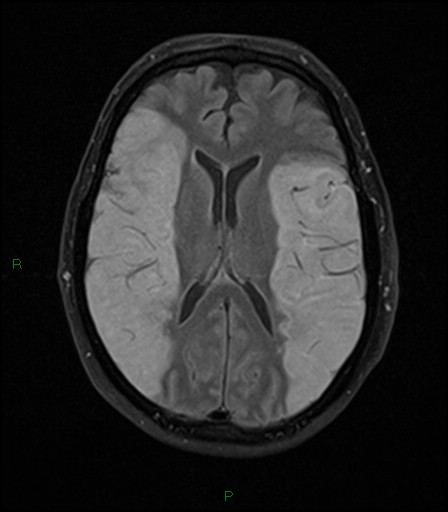 File:Bilateral acute middle cerebral artery territory infarcts (Radiopaedia 77319-89402 Axial FLAIR 14).jpg