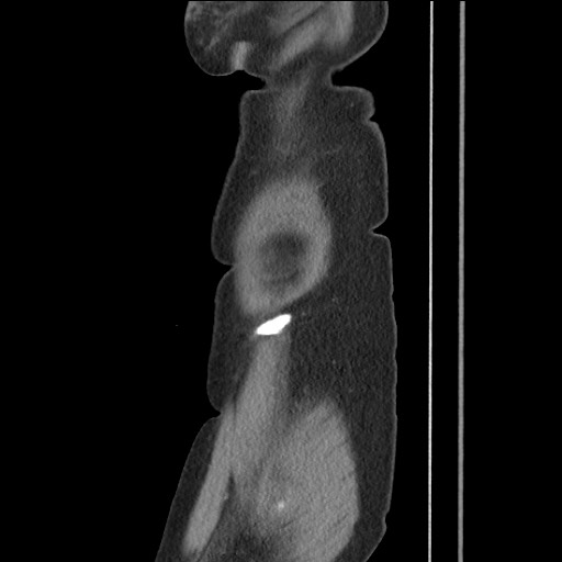 File:Bilateral adrenal granulocytic sarcomas (chloromas) (Radiopaedia 78375-91007 C 20).jpg