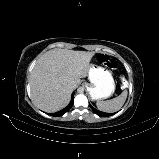 Bilateral adrenal myelolipoma (Radiopaedia 63058-71535 Axial C+ delayed 5).jpg