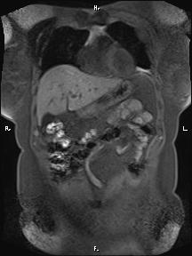 Bilateral adrenal myelolipoma (Radiopaedia 63058-71537 Coronal T1 fat sat 81).jpg