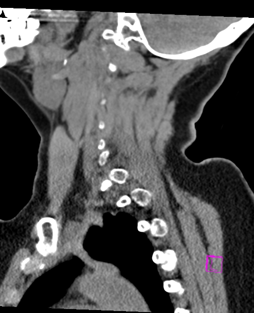 Bilateral atlanto-occipital assimilation (Radiopaedia 28350-28603 D 22).jpg