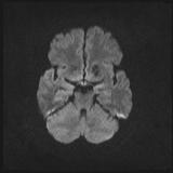 File:Bilateral basal ganglia and thalamic T1 hyperintensities (Radiopaedia 19764-19802 Axial DWI 26).jpg