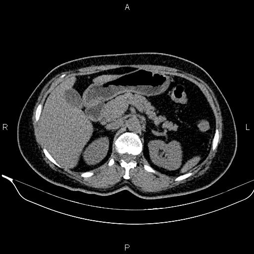 Bilateral benign adrenal adenomas (Radiopaedia 86912-103124 Axial non-contrast 40).jpg