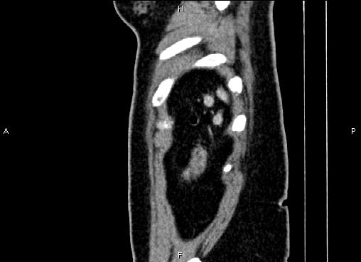 Bilateral benign adrenal adenomas (Radiopaedia 86912-103124 E 95).jpg