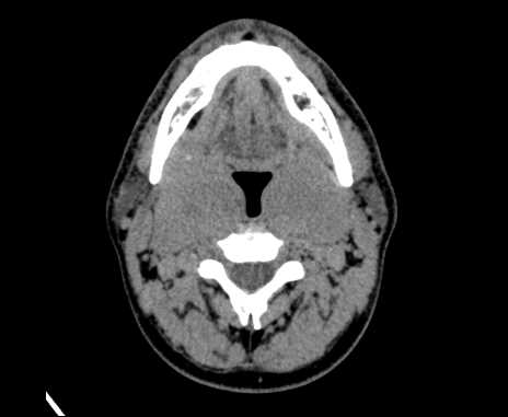 Bilateral carotid body tumors (Radiopaedia 61841-69870 Axial non-contrast 41).jpg