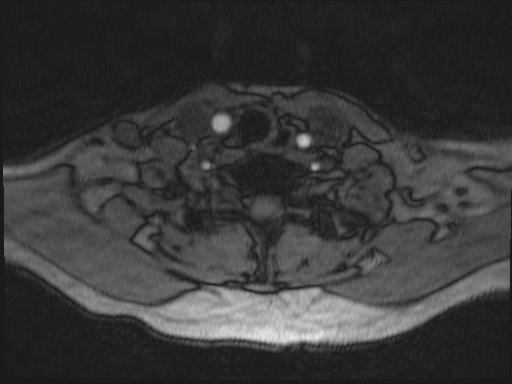 Bilateral carotid body tumors and right glomus jugulare tumor (Radiopaedia 20024-20060 Axial MRA 196).jpg
