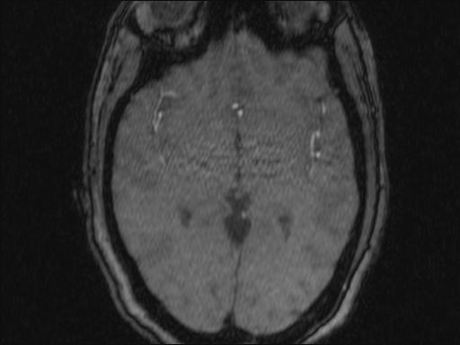 Bilateral carotid body tumors and right glomus jugulare tumor (Radiopaedia 20024-20060 Axial MRA 345).jpg