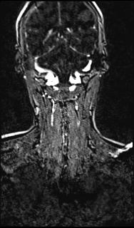 File:Bilateral carotid body tumors and right glomus jugulare tumor (Radiopaedia 20024-20060 MRA 128).jpg