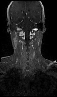 Bilateral carotid body tumors and right glomus jugulare tumor (Radiopaedia 20024-20060 MRA 53).jpg
