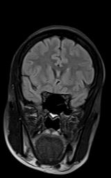 File:Bilateral carotid body tumors and right jugular paraganglioma (Radiopaedia 20024-20060 Coronal 65).jpg