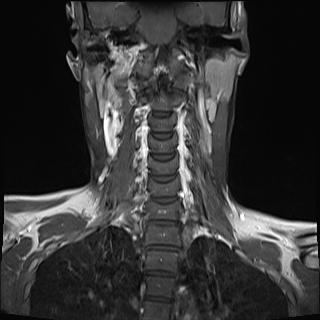 File:Bilateral carotid body tumors and right jugular paraganglioma (Radiopaedia 20024-20060 None 10).jpg