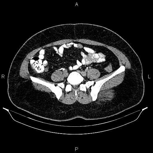 File:Bilateral ovarian dermoid cysts (Radiopaedia 85785-101603 Axial C+ delayed 54).jpg