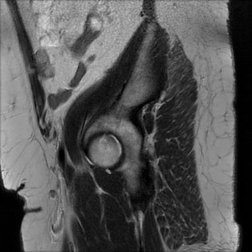 File:Bilateral ovarian dermoid cysts (Radiopaedia 90152-107338 Sagittal T2 1).jpg