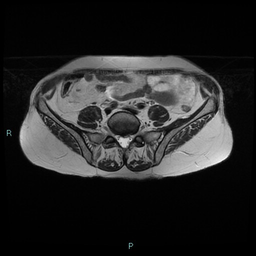 File:Bilateral ovarian fibroma (Radiopaedia 44568-48293 Axial T2 2).jpg