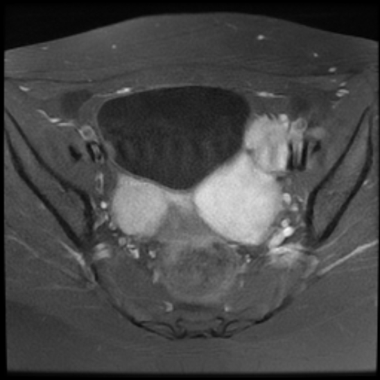 File:Bilateral ovarian fibrothecomas - adolescent (Radiopaedia 86604-102707 Axial T1 C+ fat sat 15).jpg