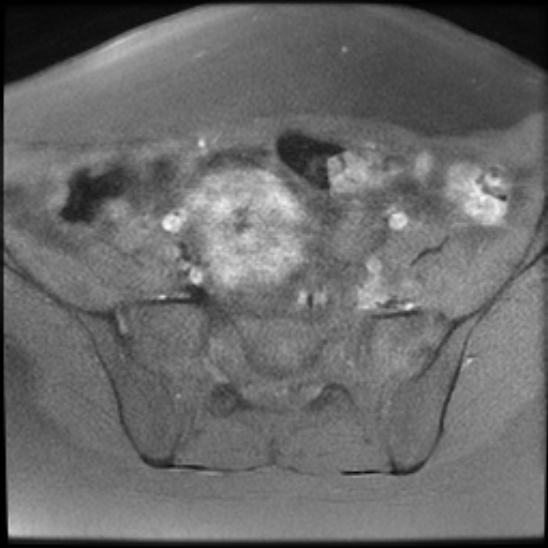 File:Bilateral ovarian fibrothecomas - adolescent (Radiopaedia 86604-102707 Axial T1 fat sat 8).jpg