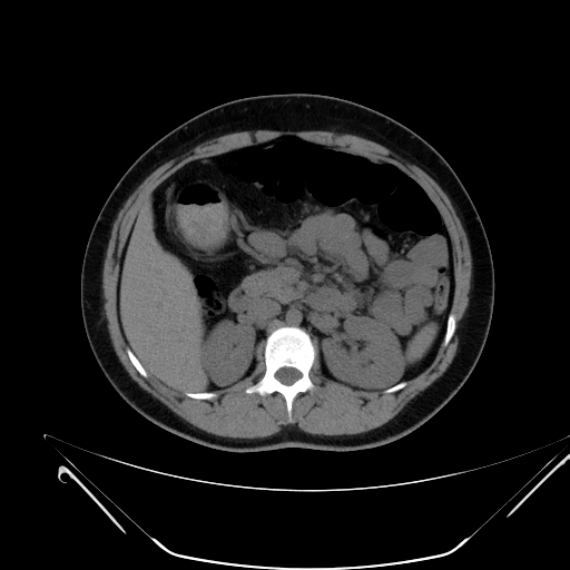 File:Bilateral ovarian mature cystic teratomas (Radiopaedia 79373-92457 Axial non-contrast 15).jpg