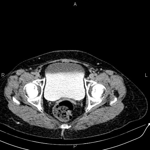 Bilateral ovarian serous cystadenocarcinoma (Radiopaedia 86062-101989 Axial C+ delayed 77).jpg
