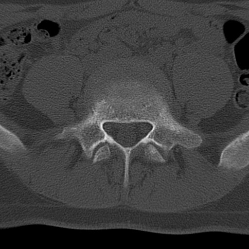 File:Bilateral pars defect (Radiopaedia 26691-26846 Axial bone window 49).jpg