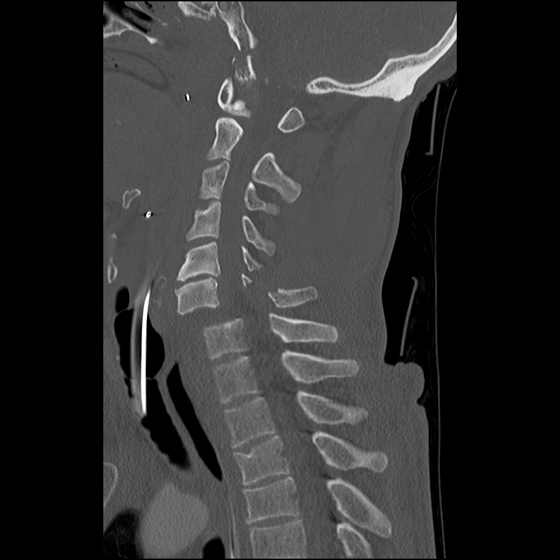 Bilateral perched facets with cord injury (Radiopaedia 45587-49713 Sagittal bone window 29).jpg
