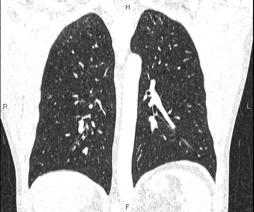 Bilateral pulmonary AVM (Radiopaedia 83134-97505 Coronal lung window 53).jpg
