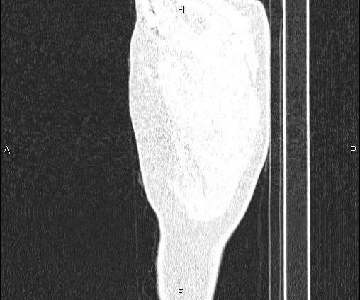 Bilateral pulmonary AVM (Radiopaedia 83134-97505 Sagittal lung window 10).jpg