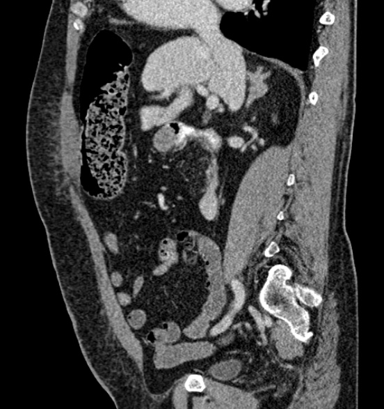 Bilateral rectus sheath hematomas (Radiopaedia 50778-56252 B 33).jpg