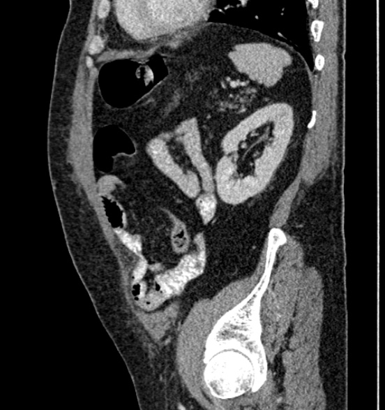 File:Bilateral rectus sheath hematomas (Radiopaedia 50778-56252 B 60).jpg